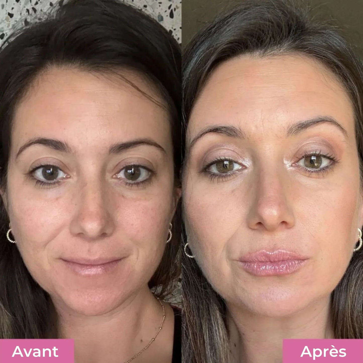 GlowLips™ - LipLift Set
